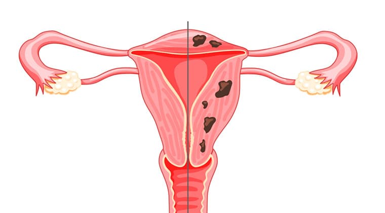 Adenomiosis