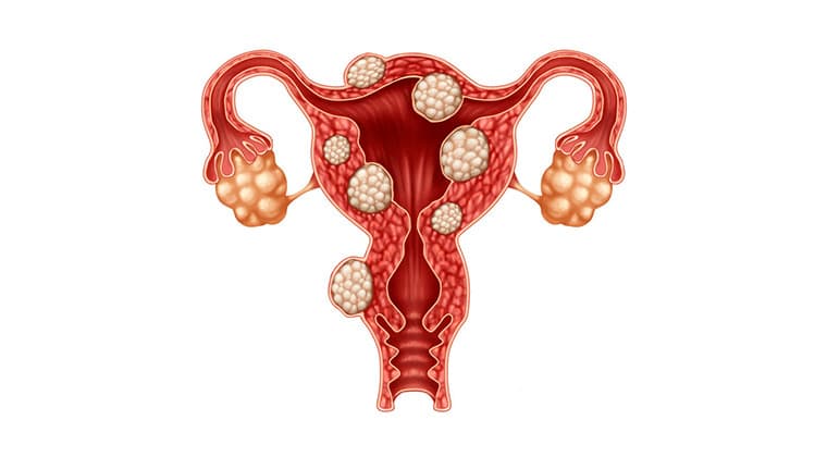 Endometriosis