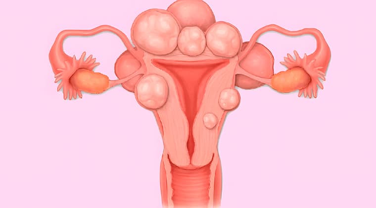 Miomas uterinos
