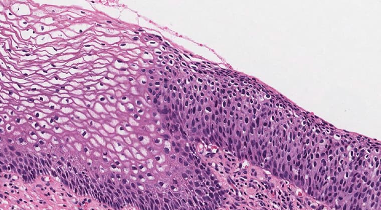 Neoplasia intraepitelial cervical