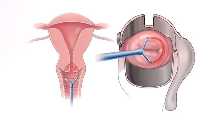 Conización de cuello uterino