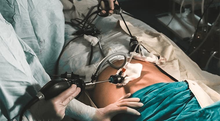 Miomectomía por histeroscopia y laparoscopia