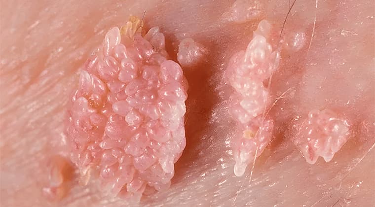 Tratamiento de condilomas vulvares, vaginales o perianales